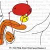 Prostate Carcinoma Prostate Carcinoma