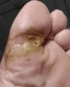 Plantar Wart in healing phase