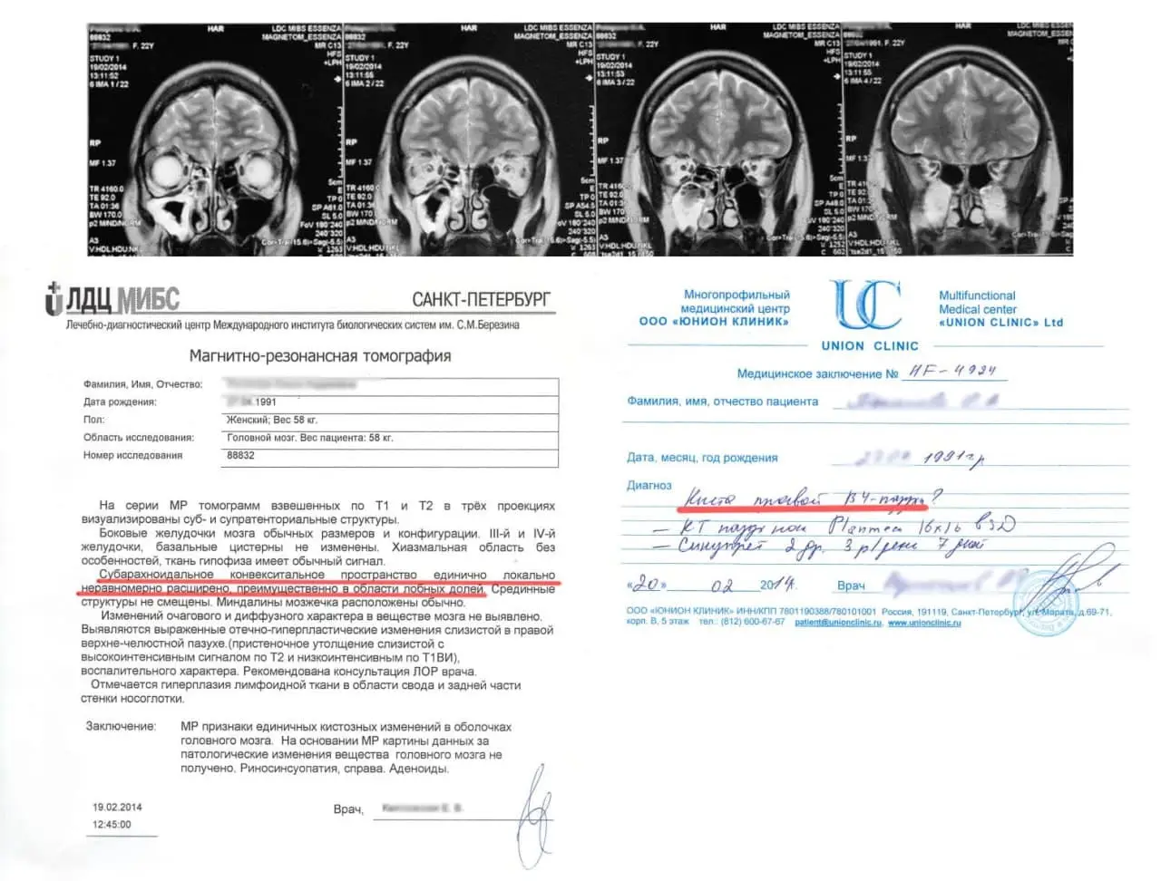 MRI finding for migraine