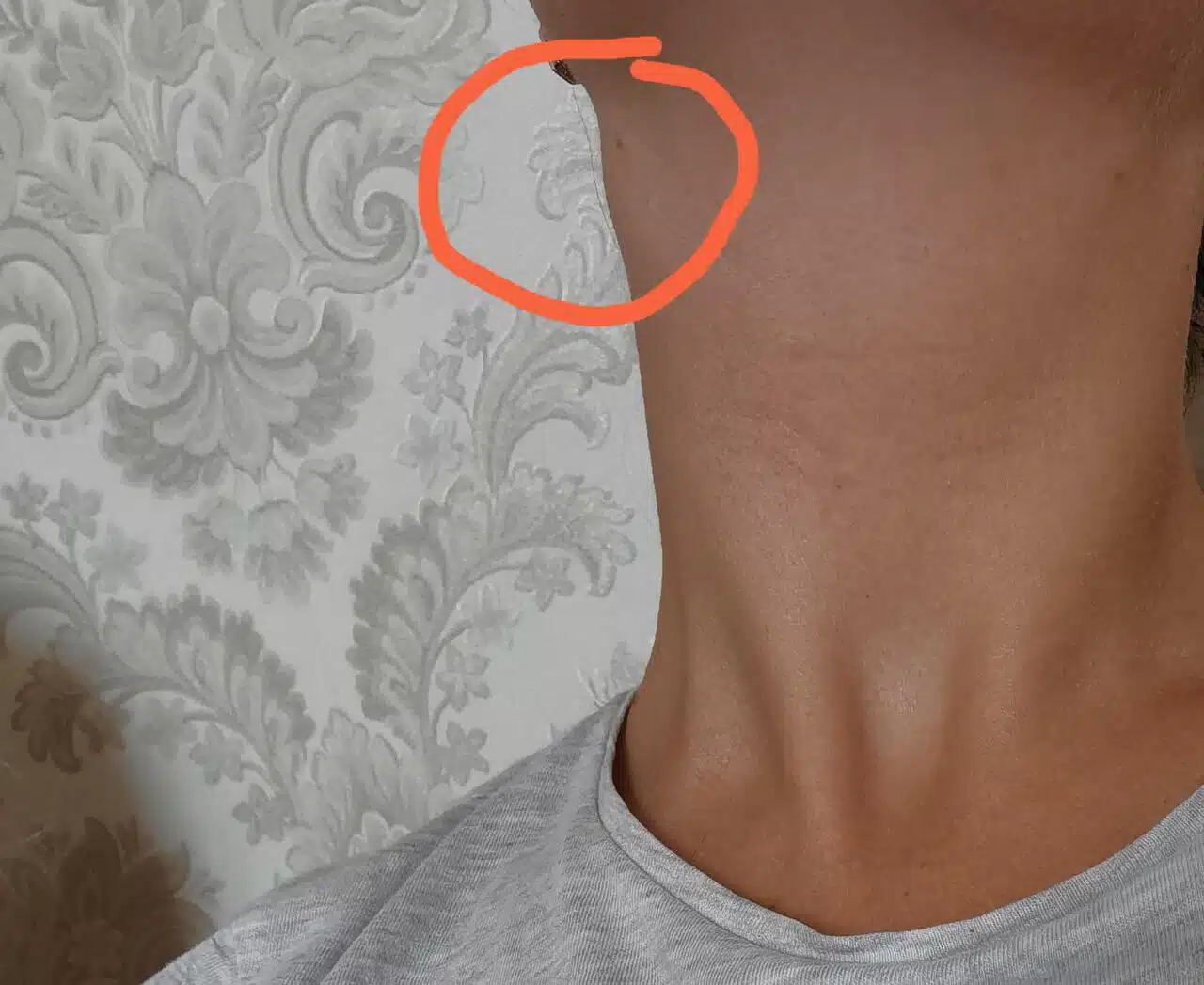 Swollen Salivary Gland